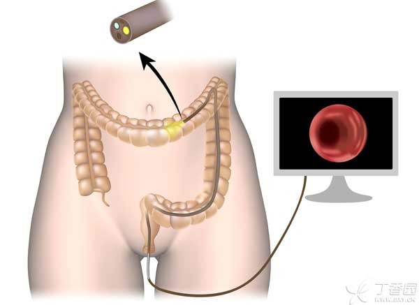 肠镜插图1-600.jpg