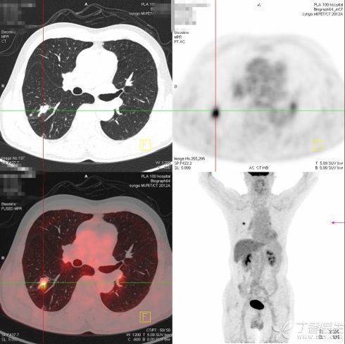 图3. PET-CT显示肺部有高亮的结节（十字中心），考虑肺癌可能.jpg