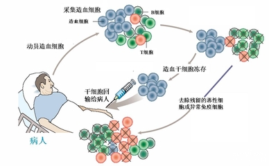 造血干细胞移植能治疗哪些疾病?利用造血干细胞移植治疗的疾病很多.