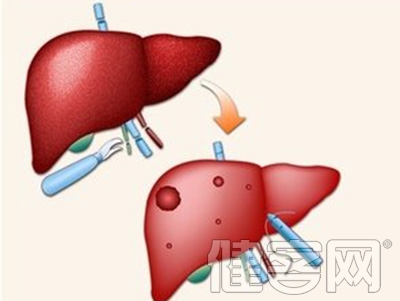 丙肝难治 成肝癌隐患