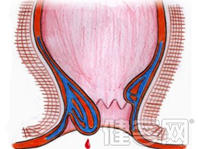 肛门癌的症状及诊断