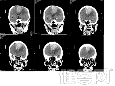 脑肿瘤临床诊断小知识